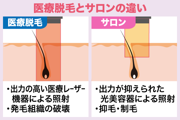 医療脱毛とサロンでのお手入れの違いを表した比較画像